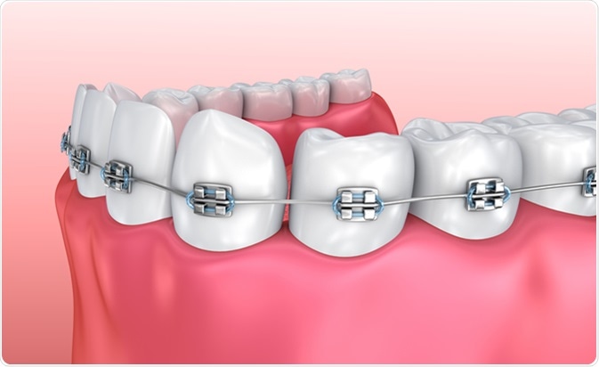 Teeth with braces isolated on white. Medically accurate 3D illustration. Image Credit: Alex Mit / Shutterstock